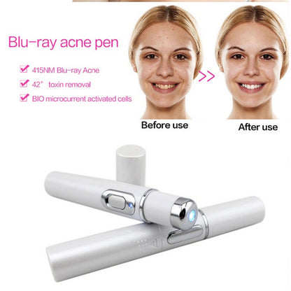 Acne Laser Pen Therapy