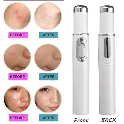 Acne Laser Pen Therapy